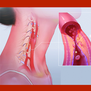 颈动脉斑块
